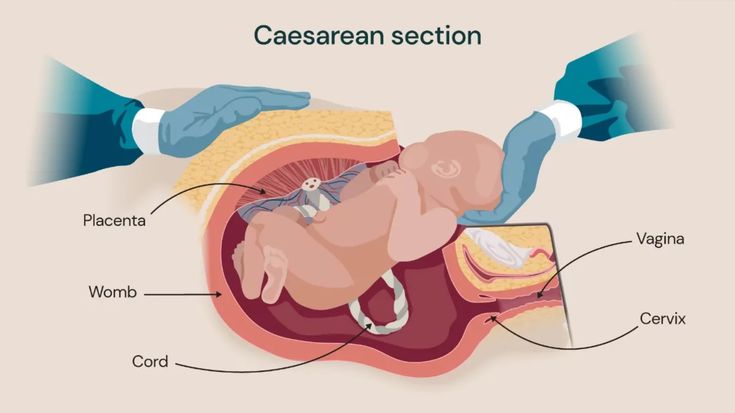 What to Expect During a Cesarean Delivery_ Guide