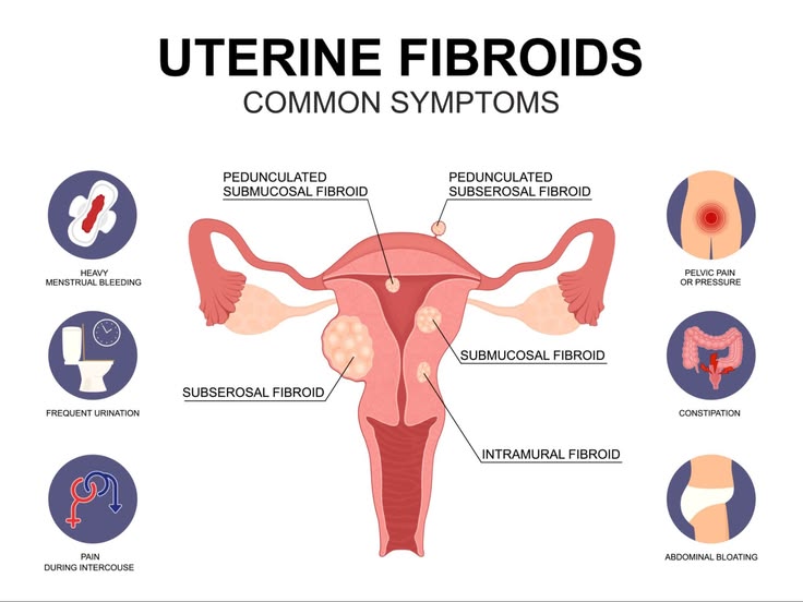 uterine Fibroids symptoms
